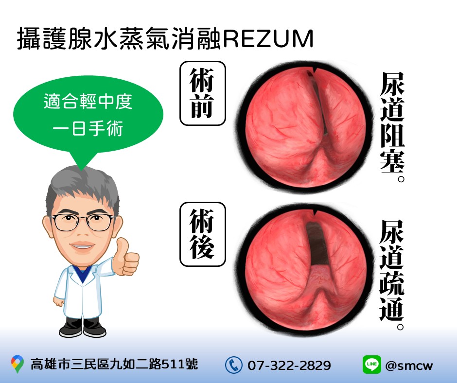 李嘉文泌尿科醫療團隊的手術介紹圖片
